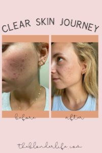 FINAL UPDATE: Clear Skin Journey