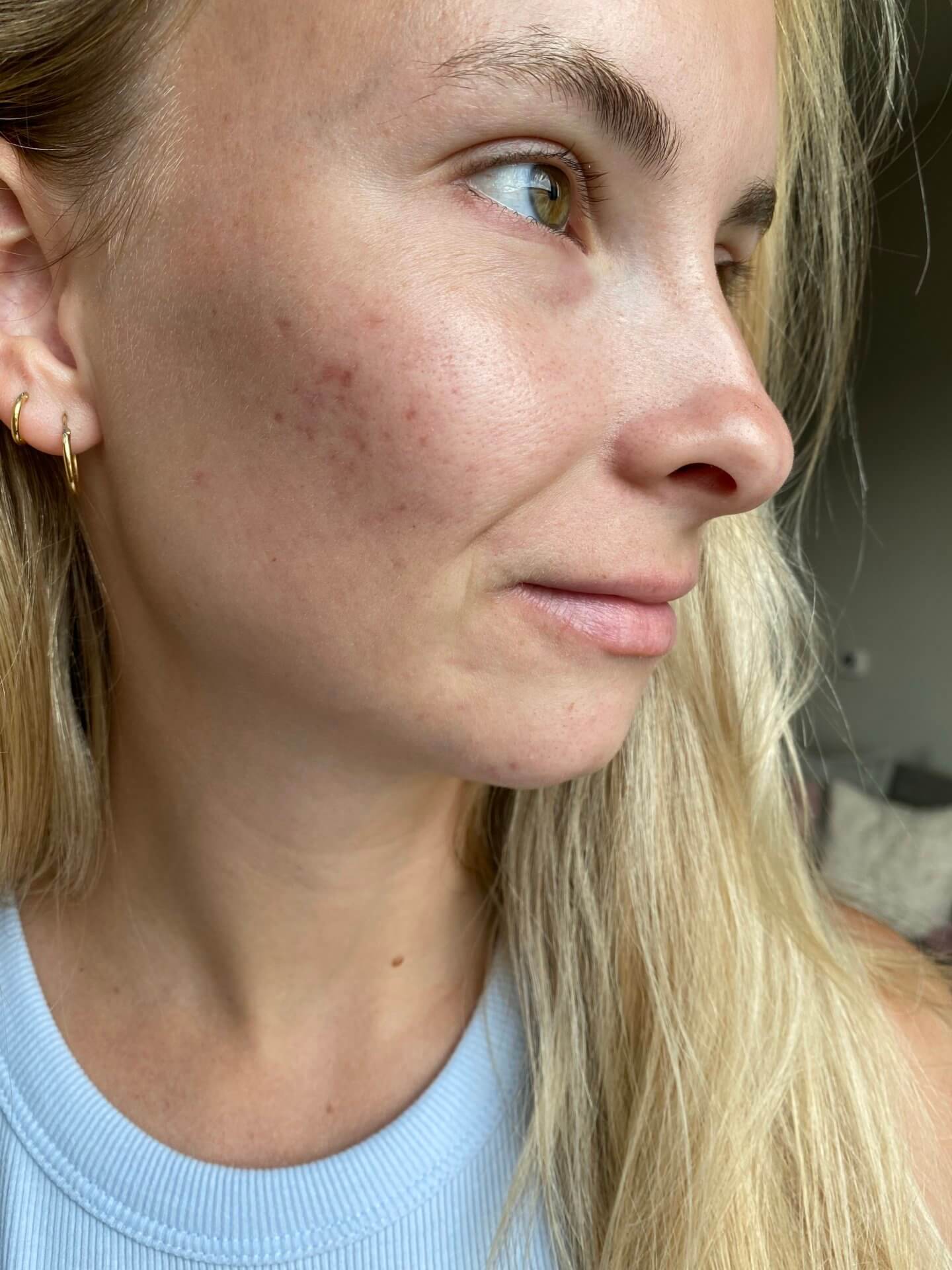 Clear Skin Routine. How I cleared up my skin. Skincare products for acne and acne scarring. Healthy healing skin care routine. The Blonder Life